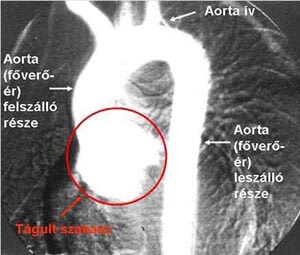 Aortoanulectasia (főverőér kezdeti szakaszának tágulata) (Kép forrása: MNSZA)