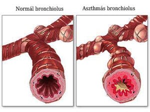 Normál bronchiolus és asztmás bronchiolus, Kép forrás: http://ecureme.com/