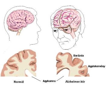 Egészséges agy és Alzheimer-kóros beteg agya